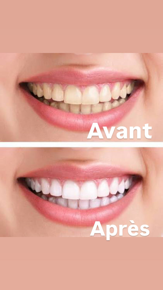 Kit de Blanchiment Dentaire