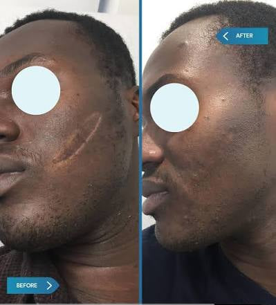 Crème Anti Cicatrice