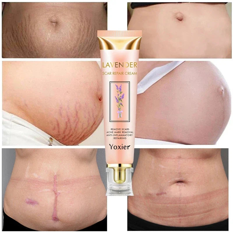 Yoxier Lavande Crème - Élimine Cicatrices, Vergetures & Chéloïdes,