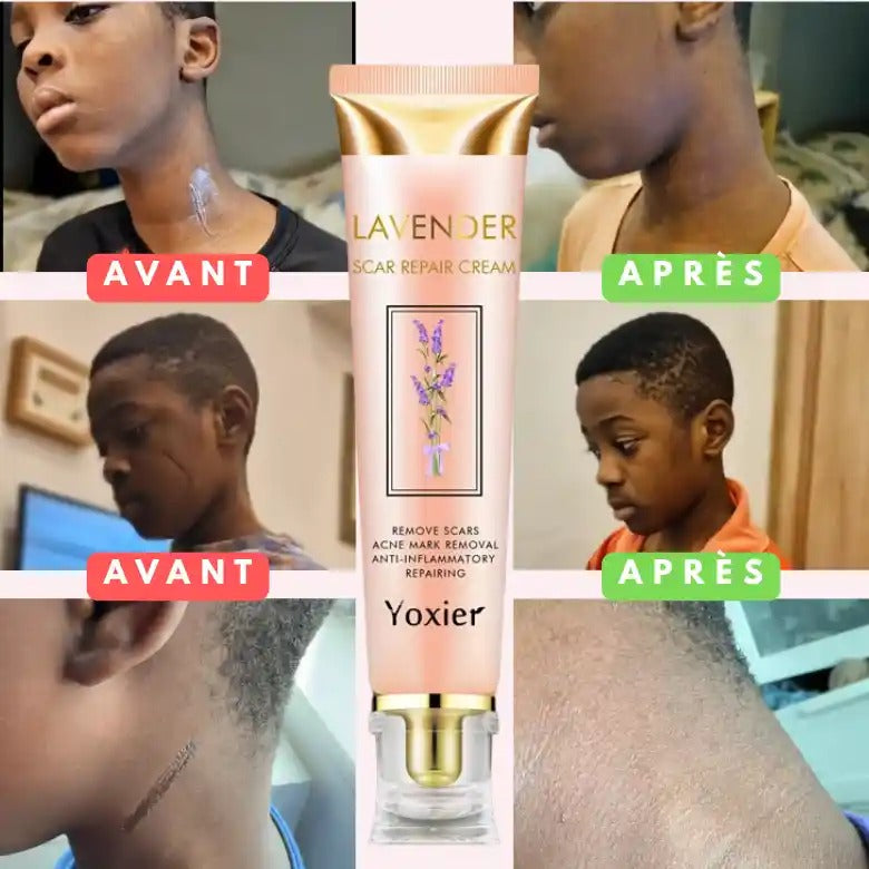 Yoxier Lavande Crème - Élimine Cicatrices, Vergetures & Chéloïdes,